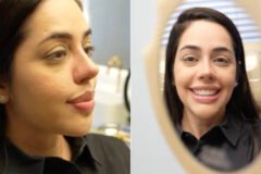 Flávia Correia mostra o resultado da cirurgia de rinoplastia no nariz