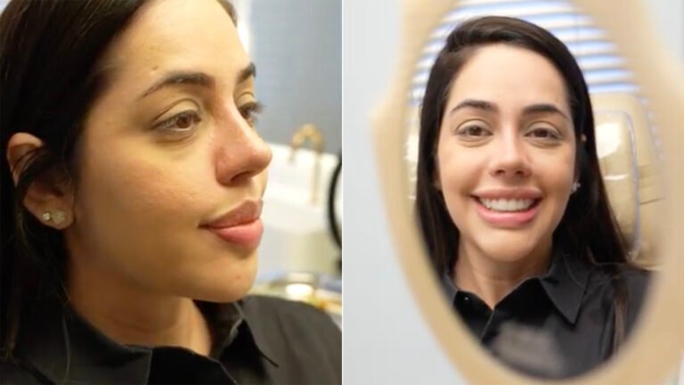 Flávia Correia mostra o resultado da cirurgia de rinoplastia no nariz